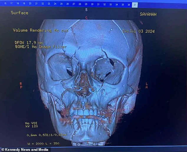 Mother Survives 'Clinically Dead' E-Scooter Accident with Brain Tissue Exposed, Defying Medical Odds