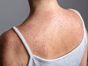 CDC Issues Urgent Warning: Measles Resurgence Sparks New Health Crisis in Texas
