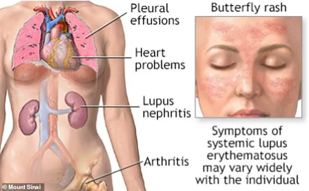 Exclusive Study Reveals Hidden Link Between Epstein-Barr Virus and Lupus