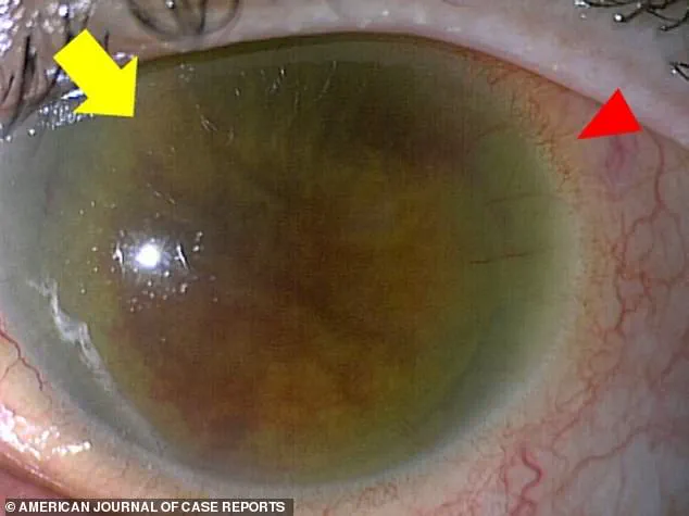 Exclusive Insight: Rare Case Reveals Hidden Dangers of Common Skin Bacteria