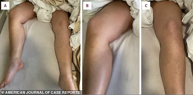 South Carolina Woman's Severe Reaction to Rosuvastatin Sparks Concerns Over Drug Safety, Used by Former President Trump