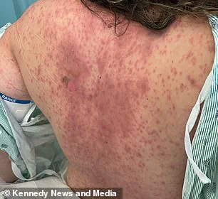Emily McAllister's Ordeal: A Rare Side Effect of Lamotrigine Leads to Devastating Skin Loss