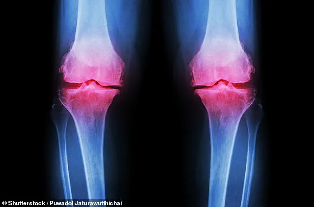 Race Against Time: Stanford Researchers Unveil Groundbreaking Regenerative Medicine Solution for UK's Arthritis Crisis