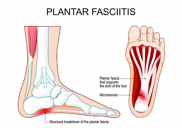 34 Million Americans Suffer from Heel Pain, a Condition Affecting All Walks of Life