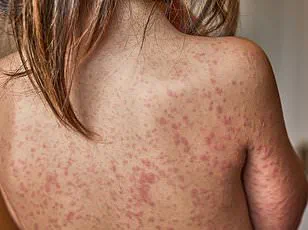 Urgent Warning: Nipah Virus Outbreak in India Sparks Global Health Alert as UK Warns of 75% Mortality Rate and Looming Pandemic Threat