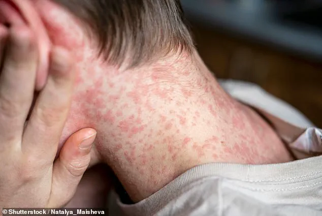 Urgent Measles Outbreak at Texas Detention Center Triggers ICE Lockdown and Public Health Alert