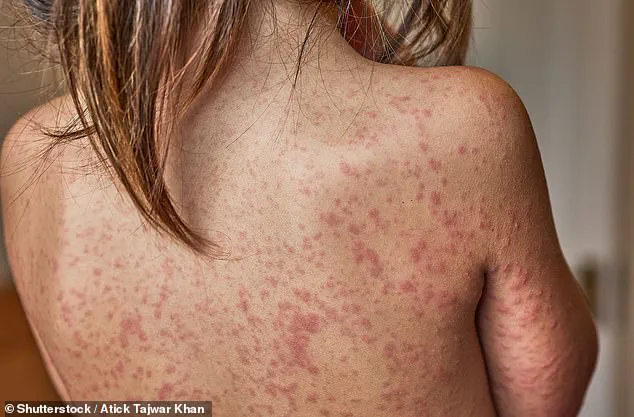 Measles Outbreak Linked to Disneyland and LAX Visits Sparks Health Investigation