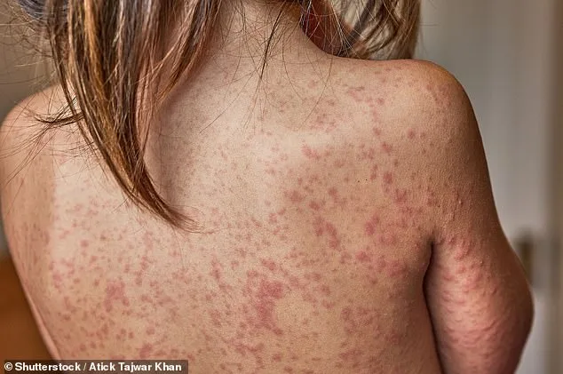 Trump Admin Launches Vaccination Push Amid South Carolina Measles Outbreak Despite Presidential Skepticism