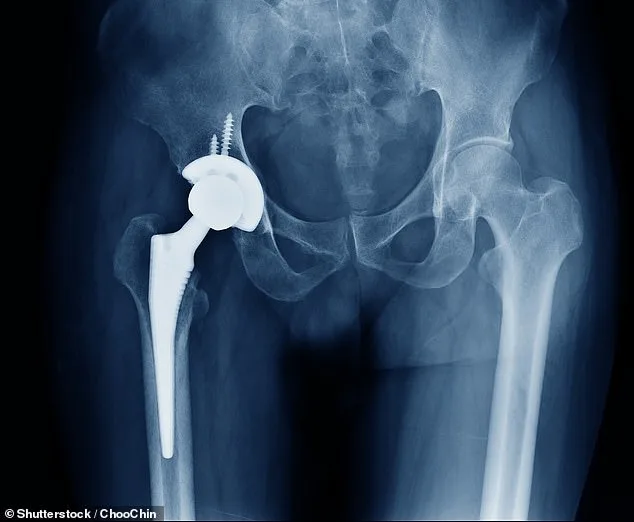 NHS Crisis: Bone Cement Shortage Threatens 800,000 Joint Surgeries Amid Heraeus Failure