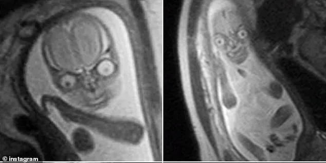 Haunting Images, Life-Saving Insights: The Fetal MRI Debate