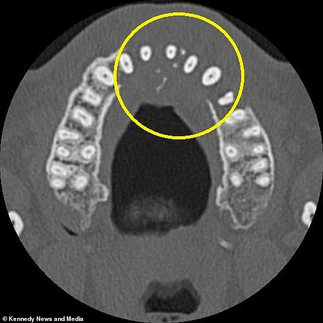 From Toothache to Blood Cancer: A Call to Take Dental Pain Seriously