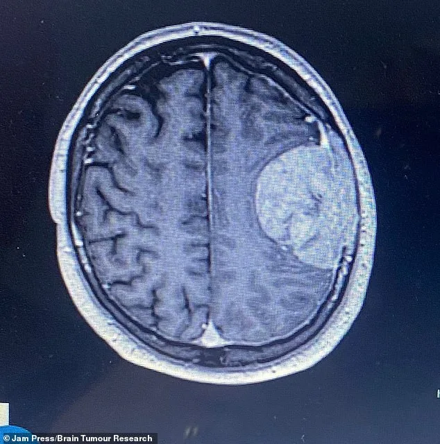 A 62-Year-Old Man's Sudden Illness Reveals Hidden Brain Tumor