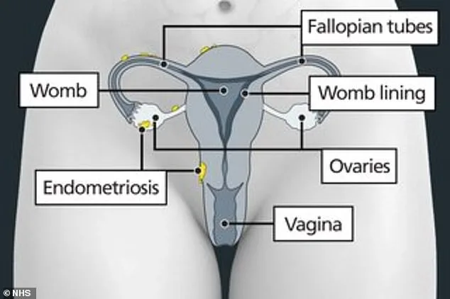 Breakthrough: Five-Minute Test Could Detect Endometriosis Years Earlier, Offering Hope to 190 Million Women Worldwide