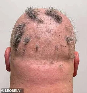 UK MHRA Approves Leqselvi, Offering New Hope for Patients with Severe Alopecia Areata