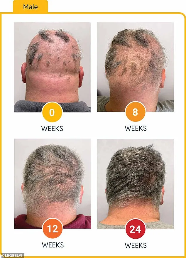 UK MHRA Approves Leqselvi, Offering New Hope for Patients with Severe Alopecia Areata