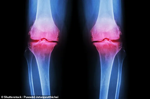 Low-Cost Fibre Supplement Offers Breakthrough in Treating Knee Osteoarthritis Pain, Study Reveals