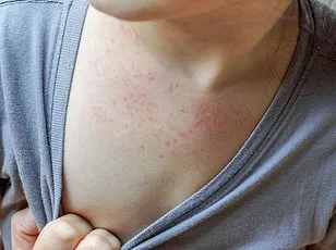 Surge in Human Metapneumovirus Raises Public Health Concerns