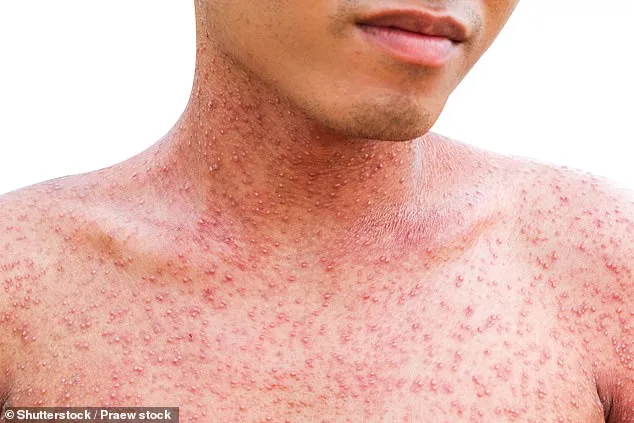 Los Angeles County Sees Record 220 Flea-Borne Typhus Cases in 2025, 90% Require Hospitalization