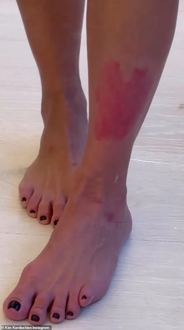 Surge in Psoriasis Cases in the UK: Social Stigma and the Need for Greater Awareness